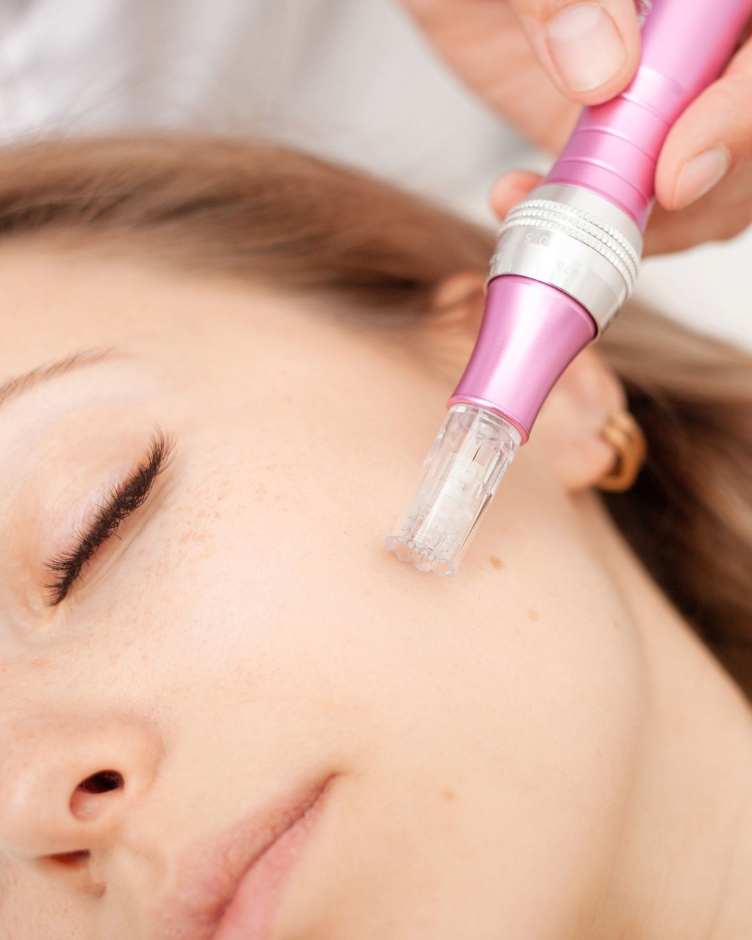 How do you take care of your skin after microneedling? 