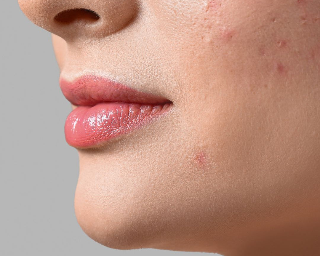 How to Minimise Pores
