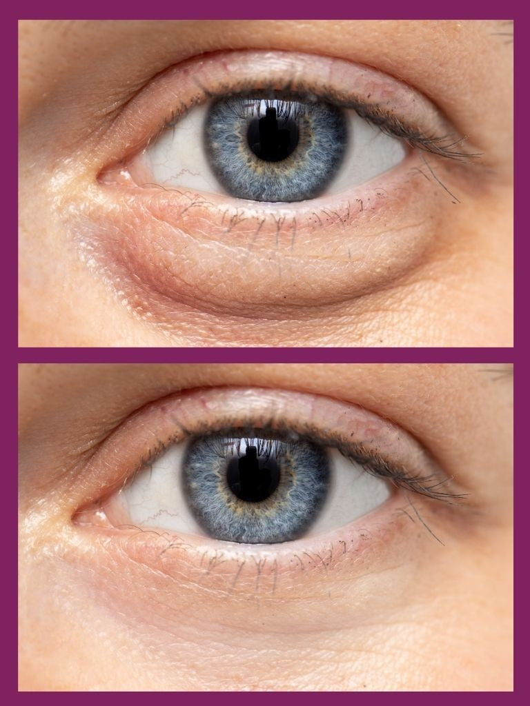 How to Get Rid of Eye Bags Fast: Instant and Long-Term Fixes