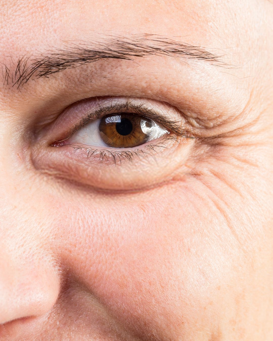 How to reduce under eye bags