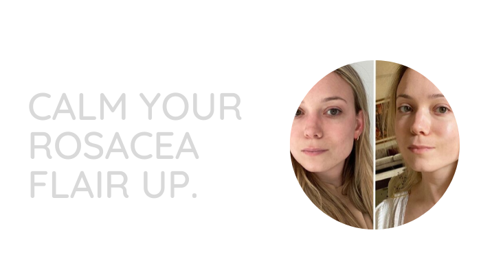 Calm your rosacea flare-ups - Dermaworks