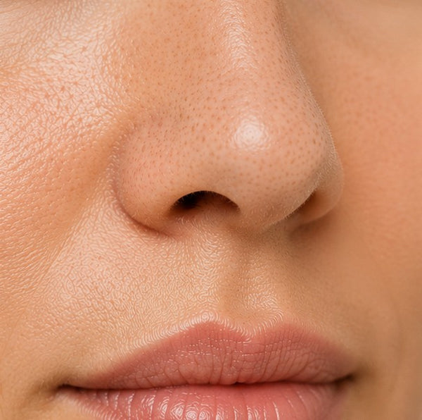 Enlarged Pores