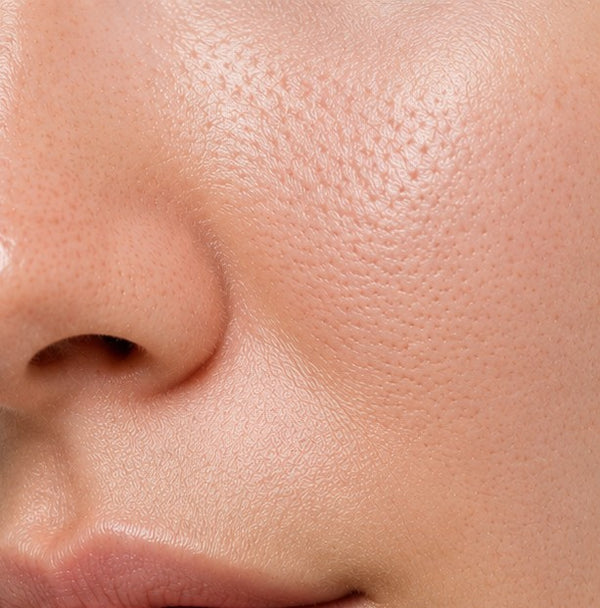 Clogged, Congested Pores