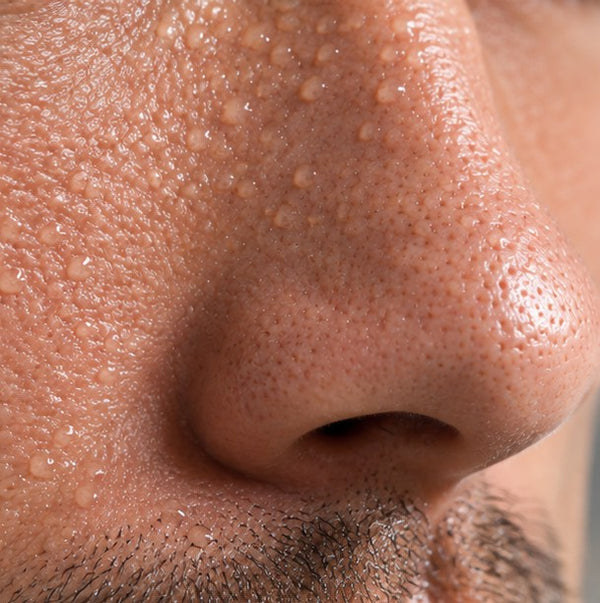 Excess Oil & Blocked Pores