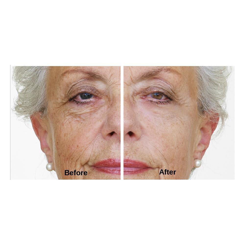 before and after dermaworks immaculift face lift cream no needles botox alternative vegan formula instantly lifted wrinkles for crows feet