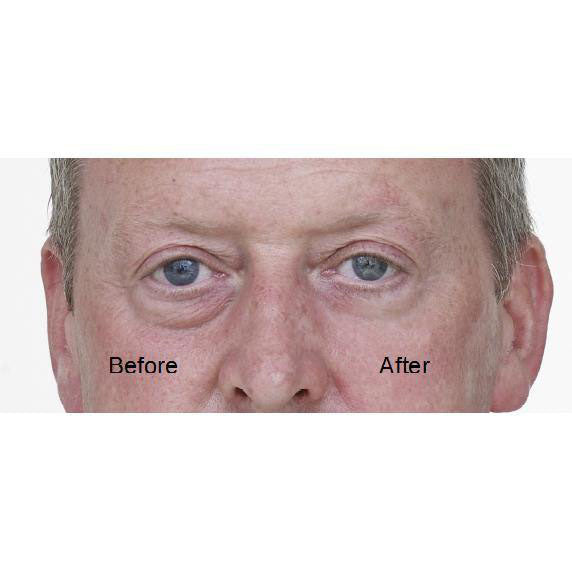 before and after instant botox without needles for men best mens anti aging product face lift 2023